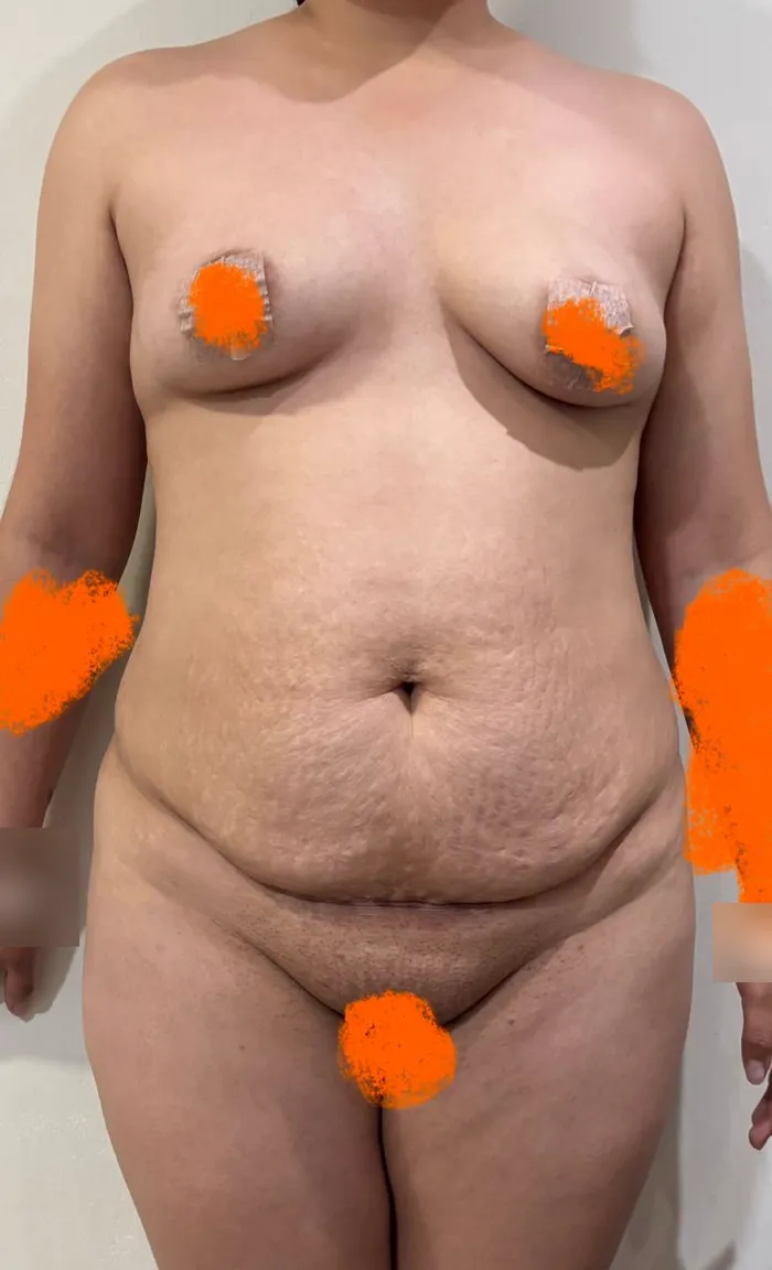 Antes de una lipoabdominoplastia en Monterrey, abdomen con piel sobrante, vista frontal