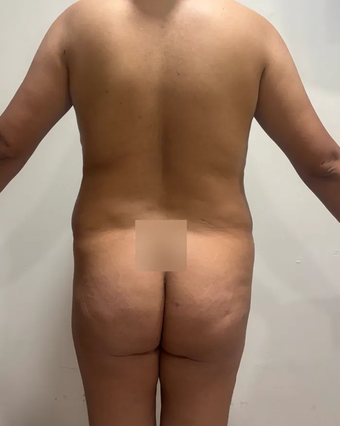 Antes de una lipoescultura en Monterrey, vista de espalda